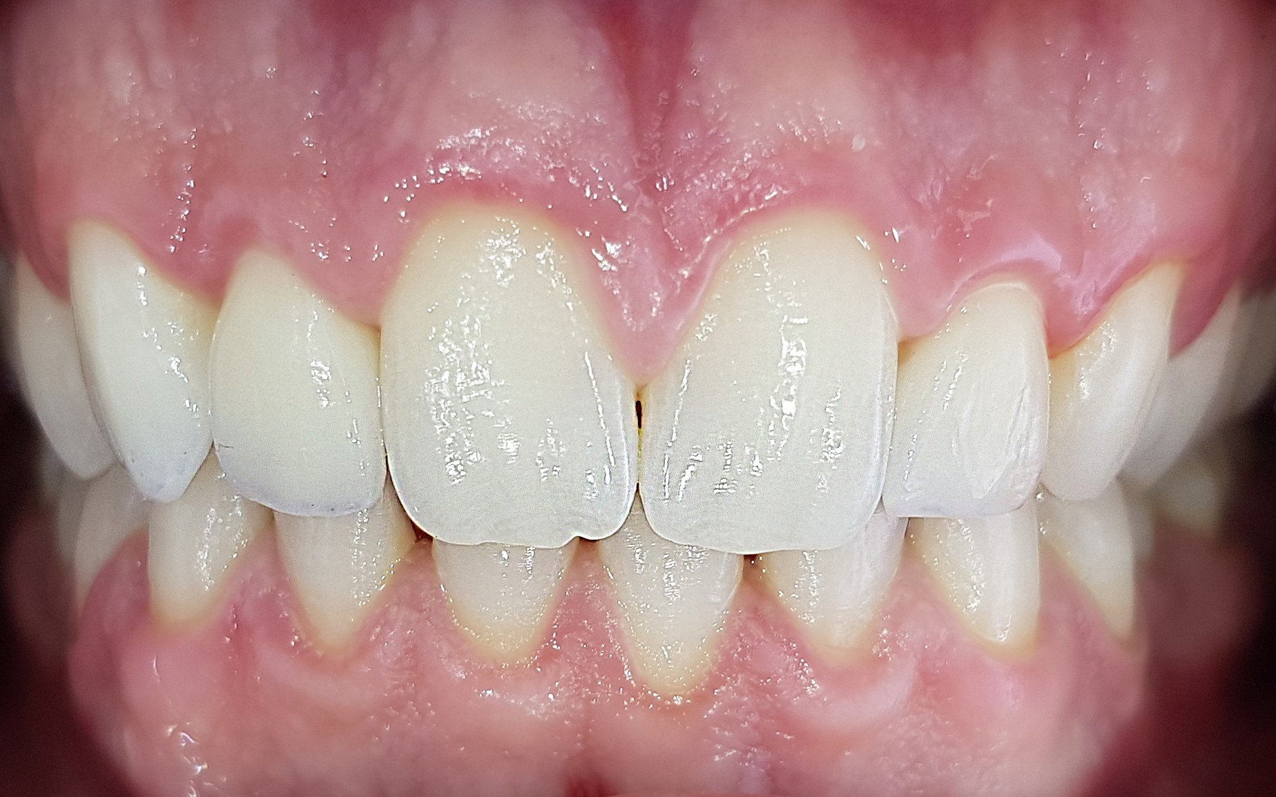 הלבנת שיניים - ד"ר פיסקוס