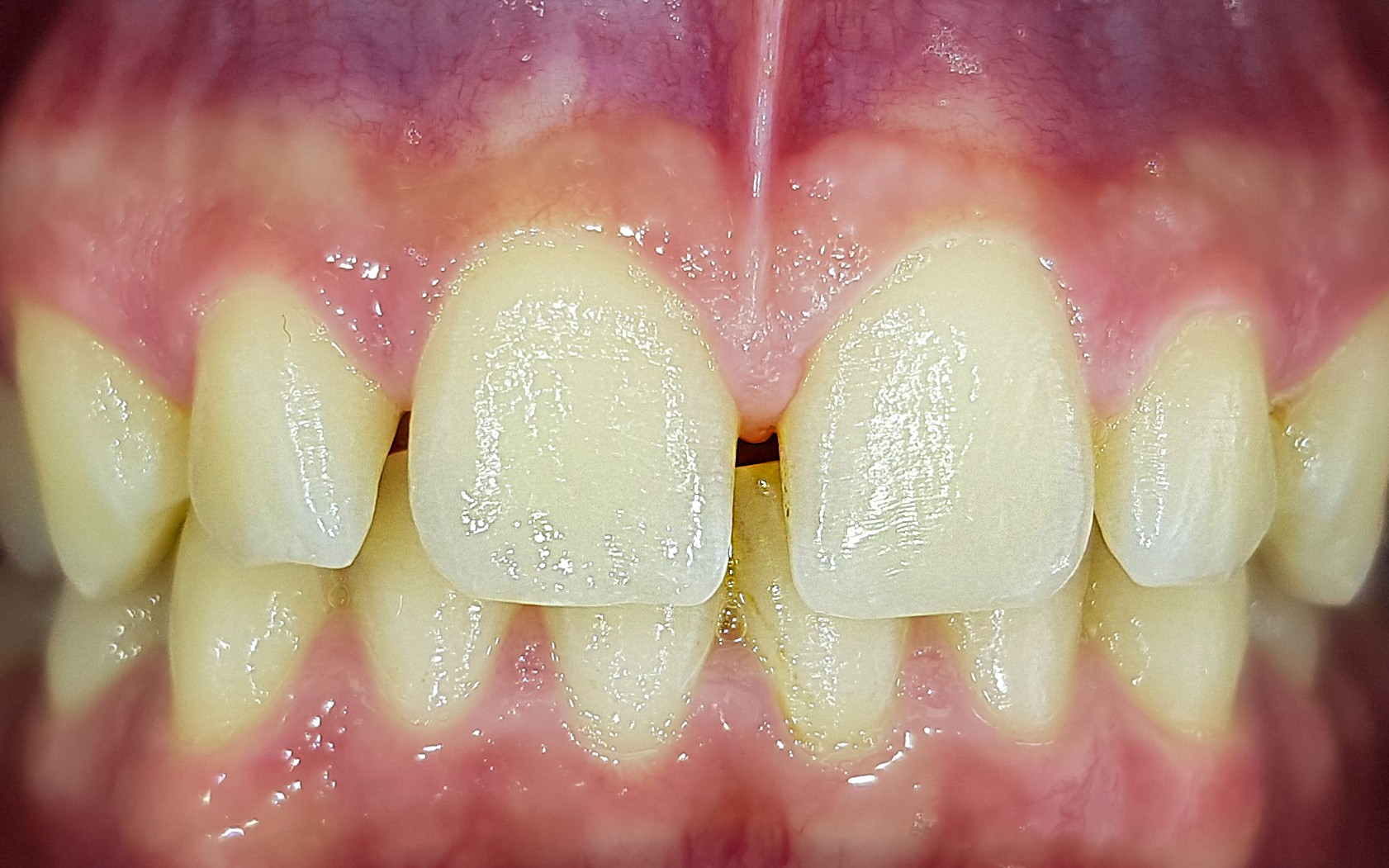 הלבנת שיניים - ד"ר פיסקוס