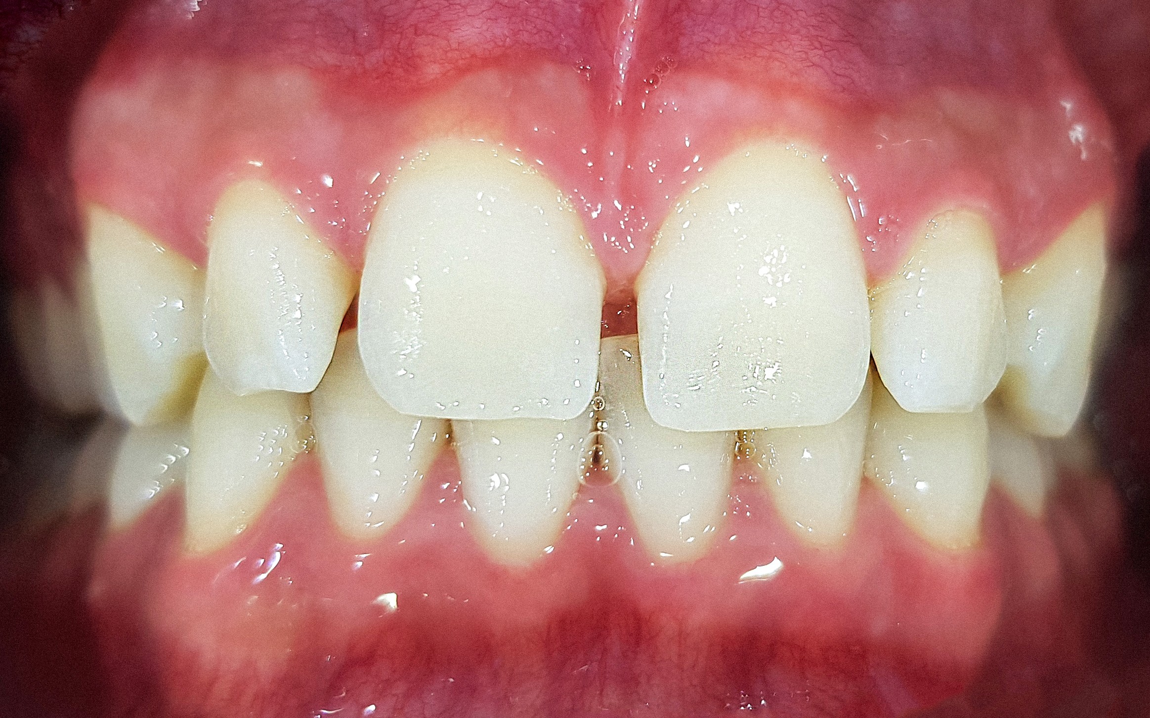 הלבנת שיניים - ד"ר פיסקוס