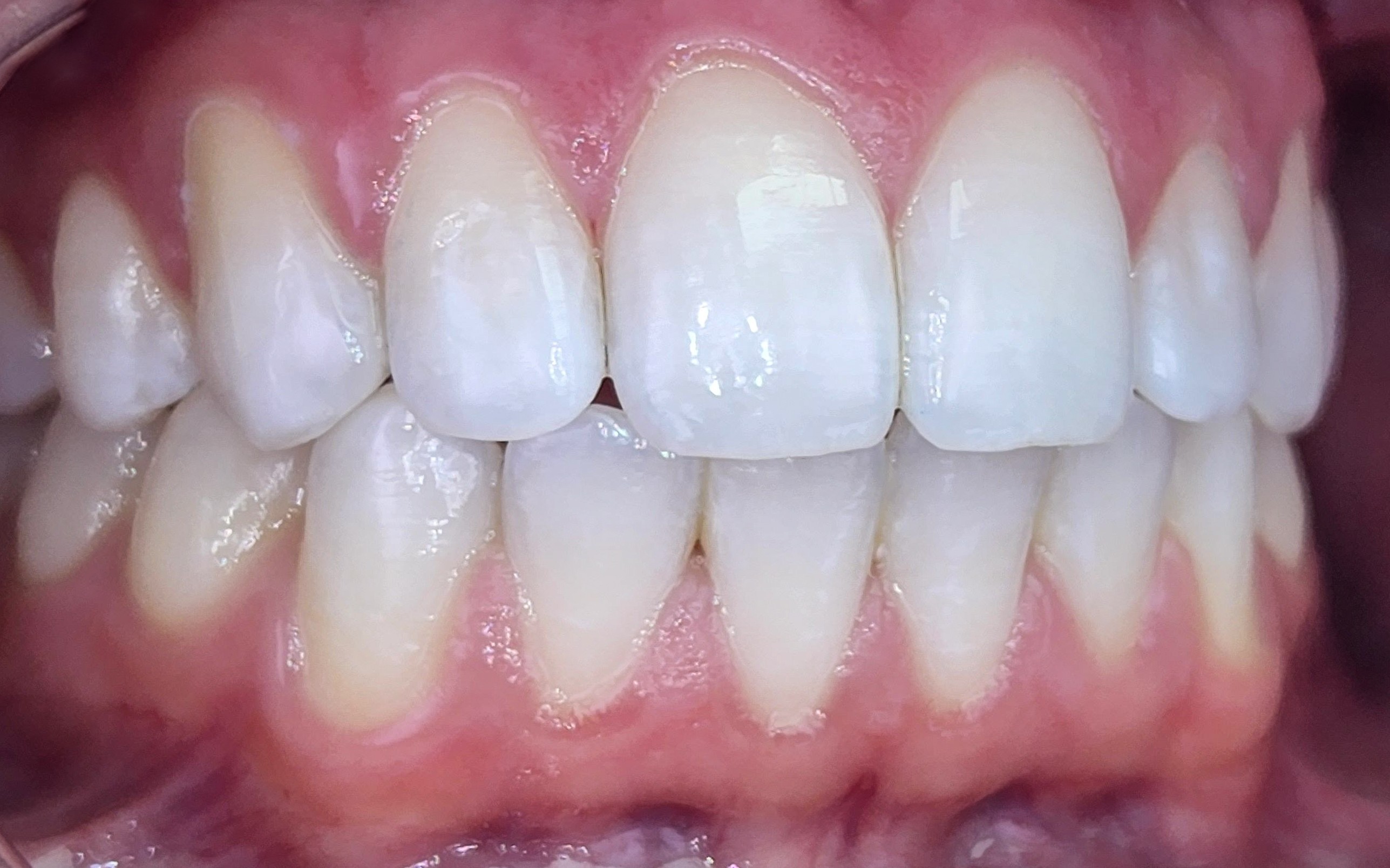 הלבנת שיניים - ד"ר פיסקוס