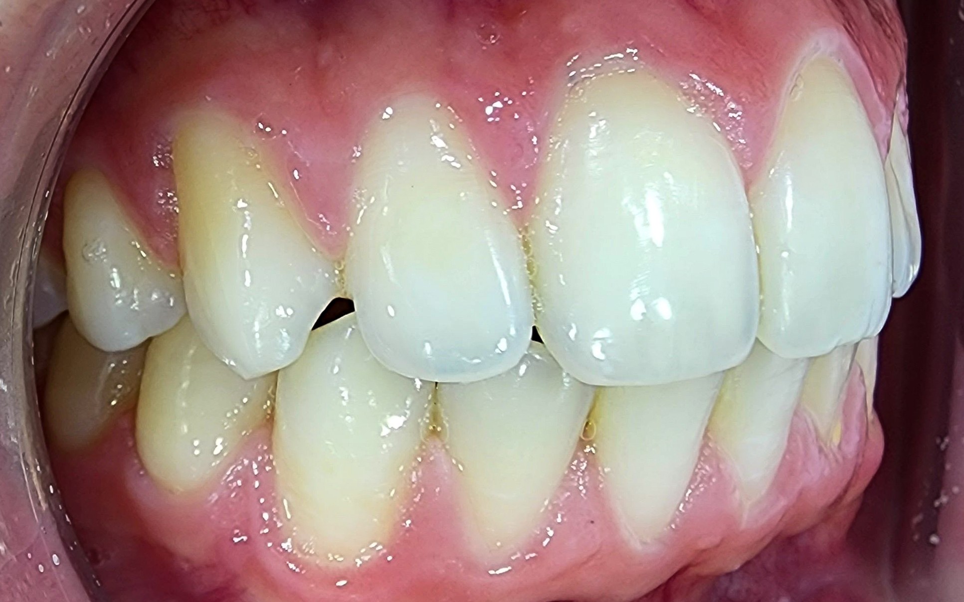 הלבנת שיניים - ד"ר פיסקוס