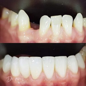 חוסר מולד של שן -לפני ואחרי הכל מתבצע אם ציפוי חרסינה ללא ניתוח ברגים ושתלים. טכניקה חדשנית של הרופא - ד"ר פיסקוס