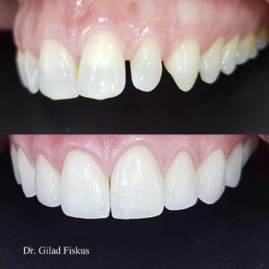 סגירת רווחים בשיניים