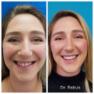 סיפור מקרה של הלבנת שיניים וחוסרים בשיניים - דר פיסקוס