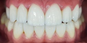 יישור שיניים ללא גשר