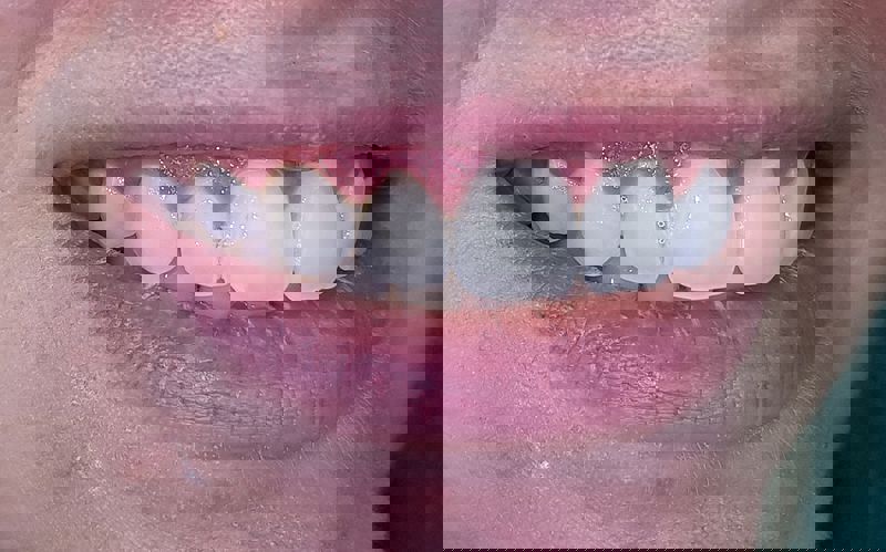 הלבנת שיניים אצל דר פיסקוס