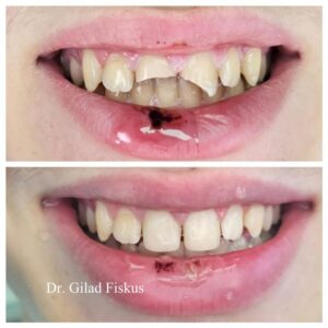 איך מתקנים שיניים שבורות